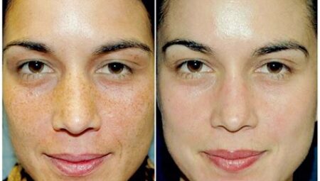 How much is a chemical peel